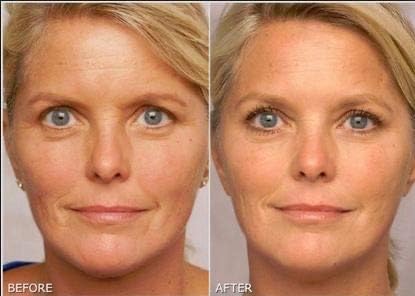 Retinol Gel 0.1 Vitamin A Repairs Fine Lines & Wrinkles, Scar Treatment, Age and Sun Spots, Anti-Aging Formula Gel 20 Grams