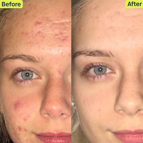 SLMD Skincare by Dr. Pimple popper - 30-Day Acne System - 4-pc Kit - 3 Steps, 2x per Day Full Routine to Treat and Prevent All Stages of Acne