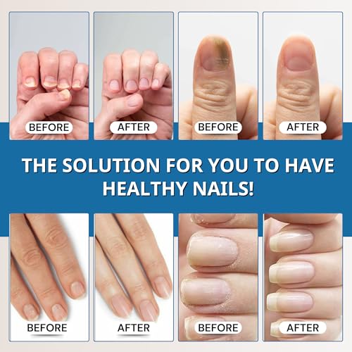 Abera Advanced Nail Repair Serum - Restorative Care for Brittle, Cracked & Discolored Nails - Supports Healthy Nails (Blue)