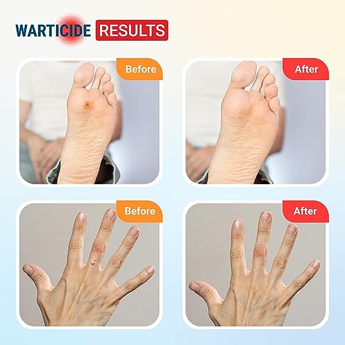 Warticide Fast-Acting Wart Remover - Plantar and Genital Wart Removal, Attacks Warts On Contact, Easy Application (1 Fluid Ounce)