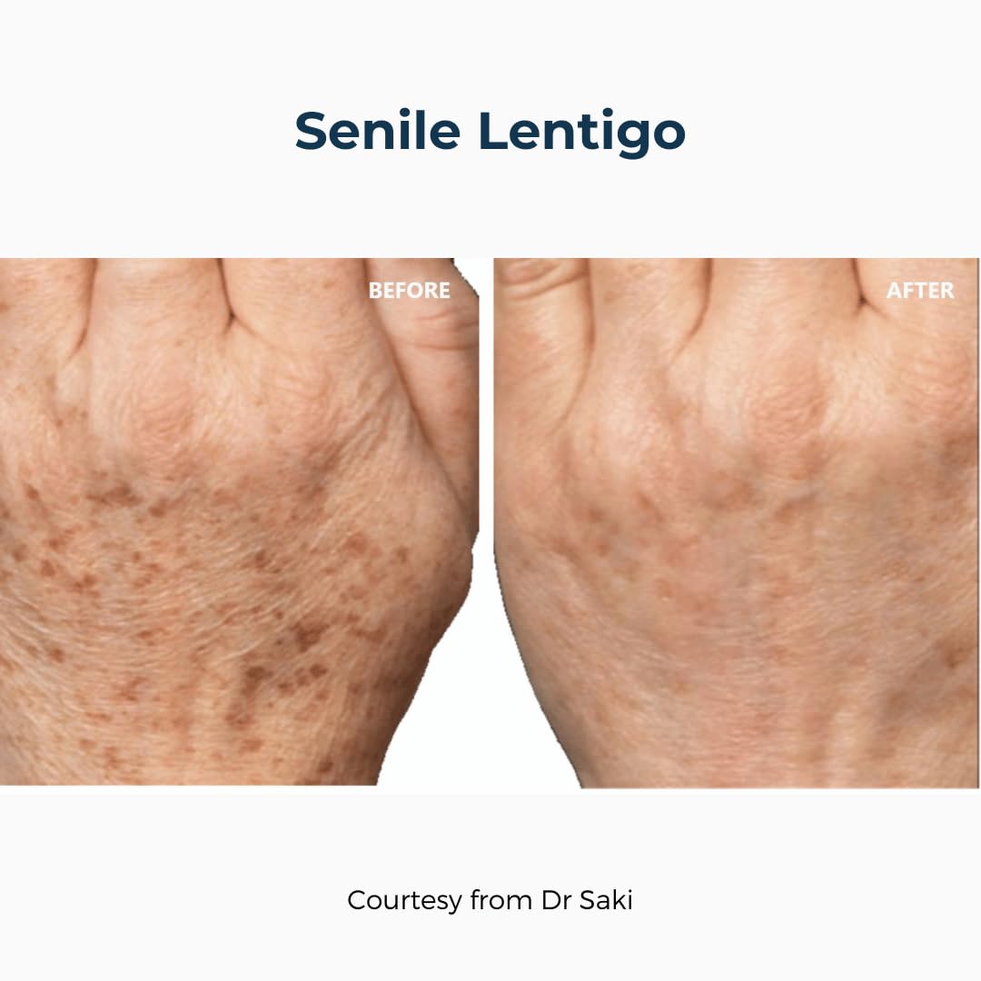 cyspera Intensive Pigment Corrector, the Original Formula, 1.75 Ounce