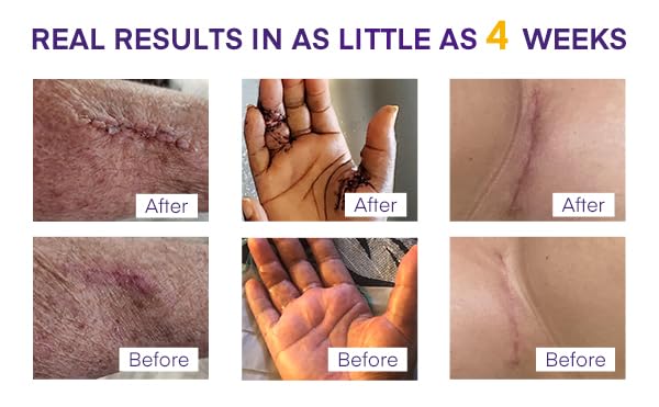 Silicone Scar Gel Scar Cream: SPF 30 Advanced Medical-Grade Formula for Surgical Scars, C-Section, Stretch Marks, Acne, Burns, Keloids, Old & New Scars – Broad Spectrum UV Protection 1.06oz (30g)