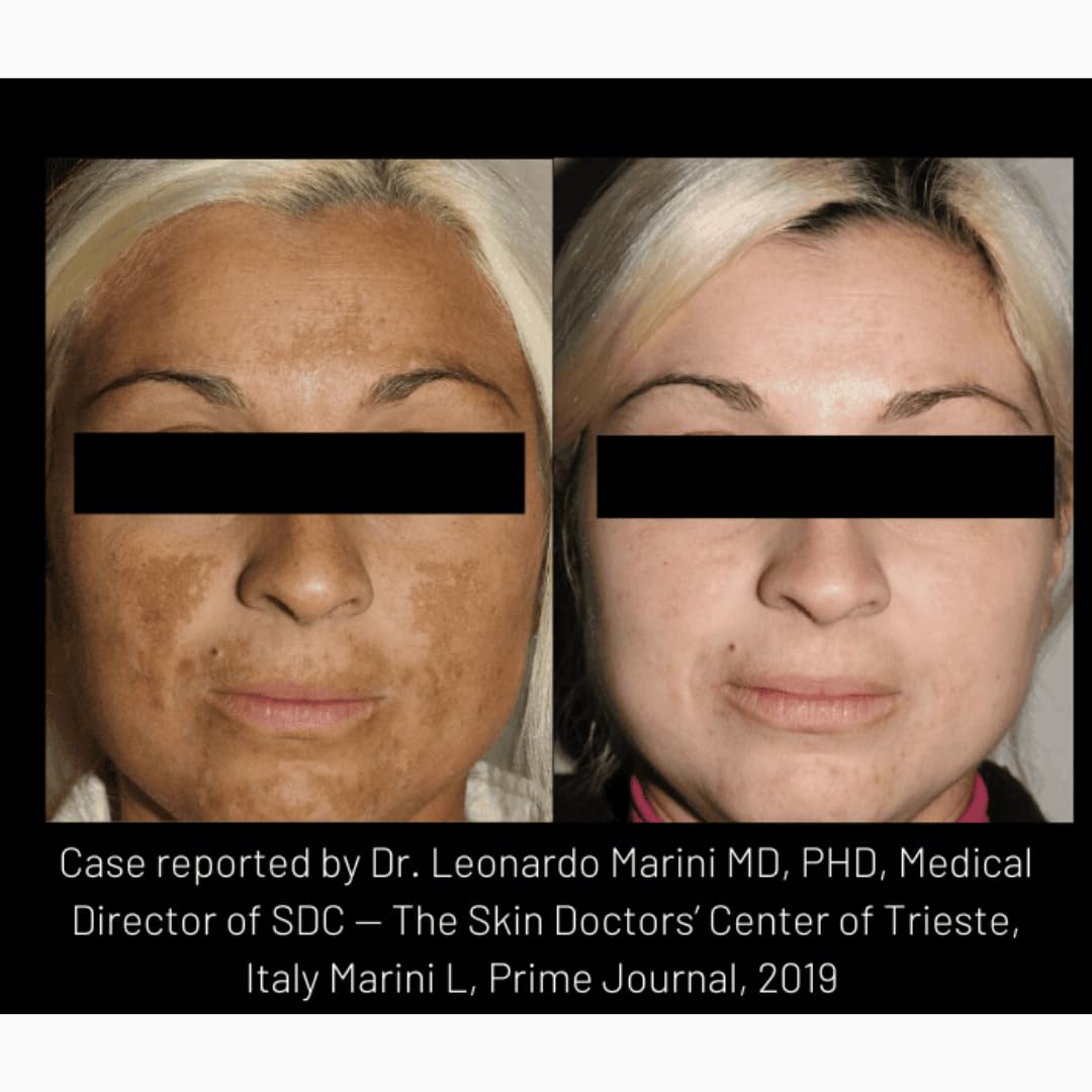 cyspera Intensive Pigment Corrector, the Original Formula, 1.75 Ounce