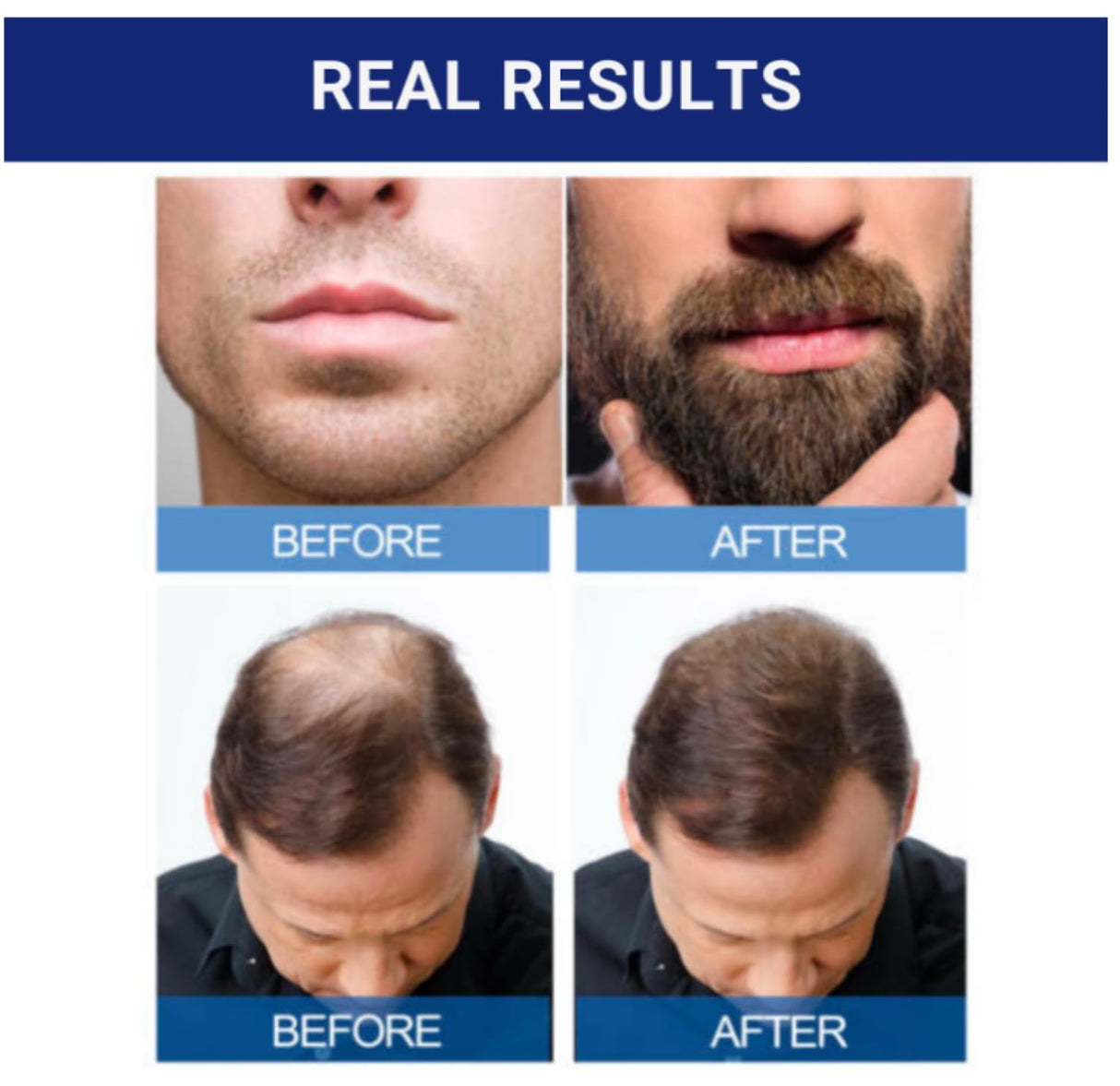 Kirkland Minoxidil 5% - 12 Month Supply for Men with General Thinning of Hair on Top of Scalp