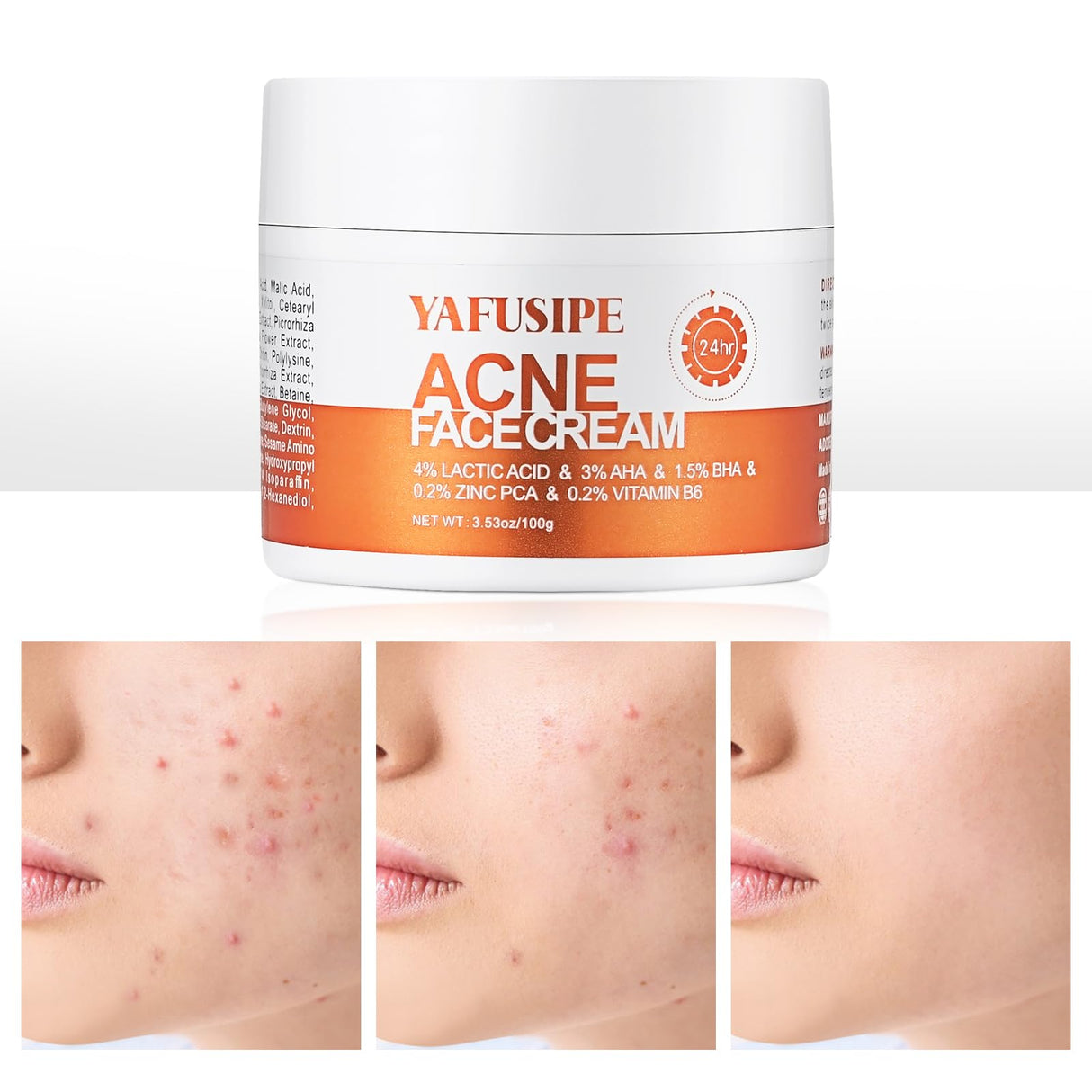 Acne Treatment for Face for Hormonal Cystic Stubborn Acne Cream for Sensitive Skin Teens Adults Women Men Spot Pimple Butt Control Rapid Clearing Breakout Overnight Face Blemish Treatment Moisturizer