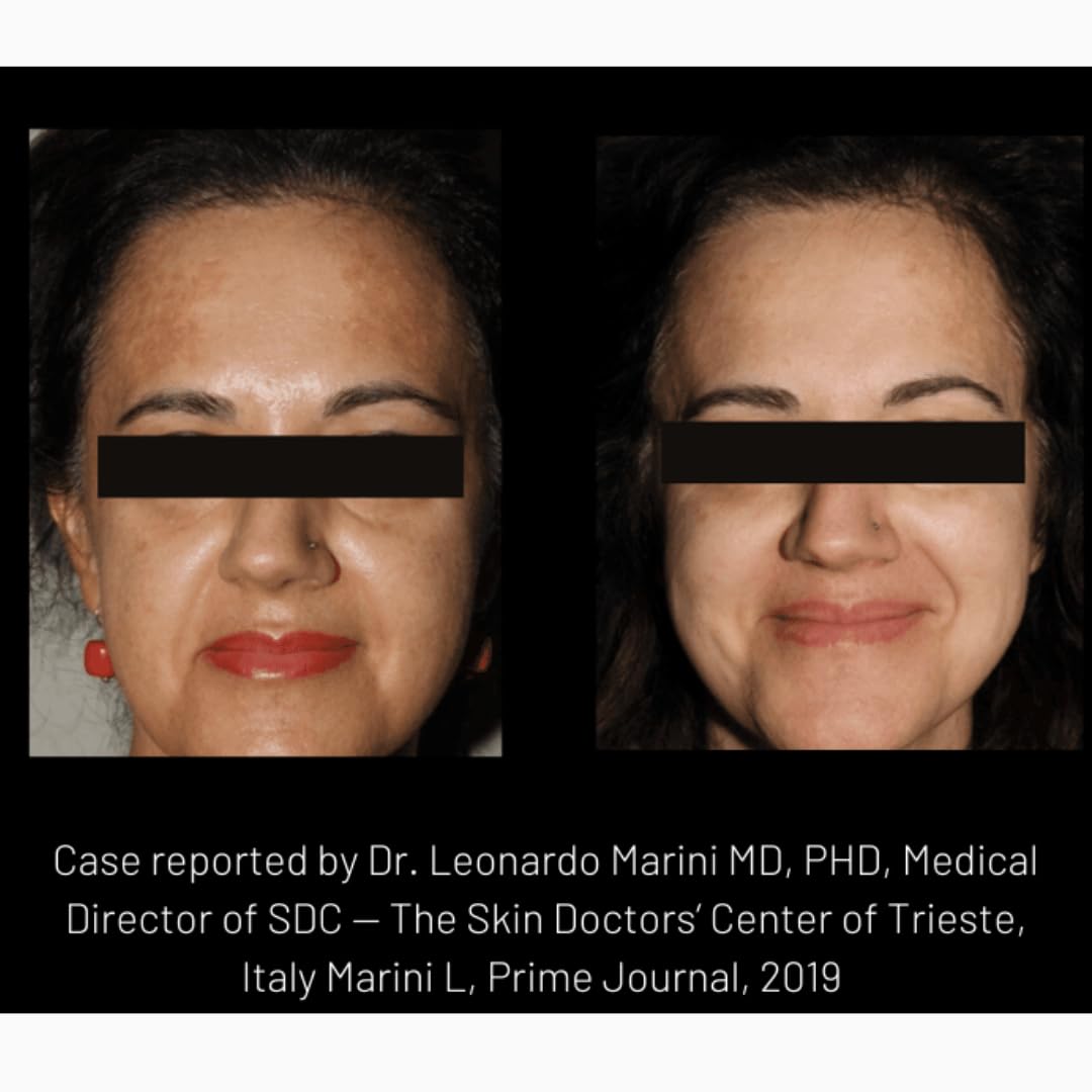 cyspera Intensive Pigment Corrector, the Original Formula, 1.75 Ounce