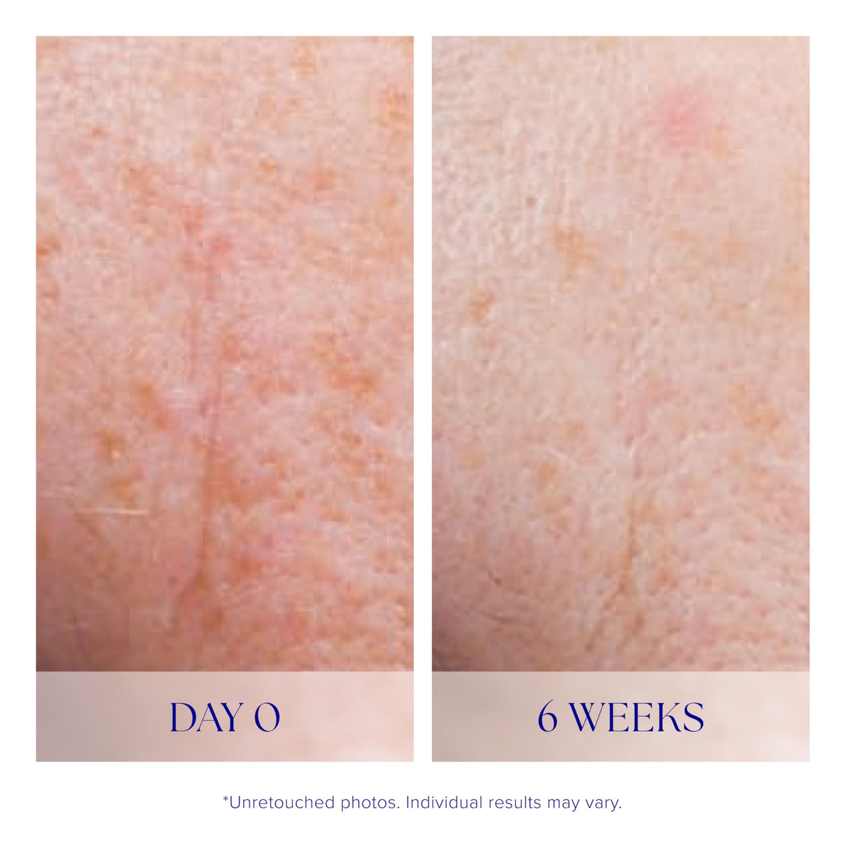 iS CLINICAL Active Serum; Face Serum, Anti-Aging, Helps skin with acne and pigmentation, 0.5 Fl Oz