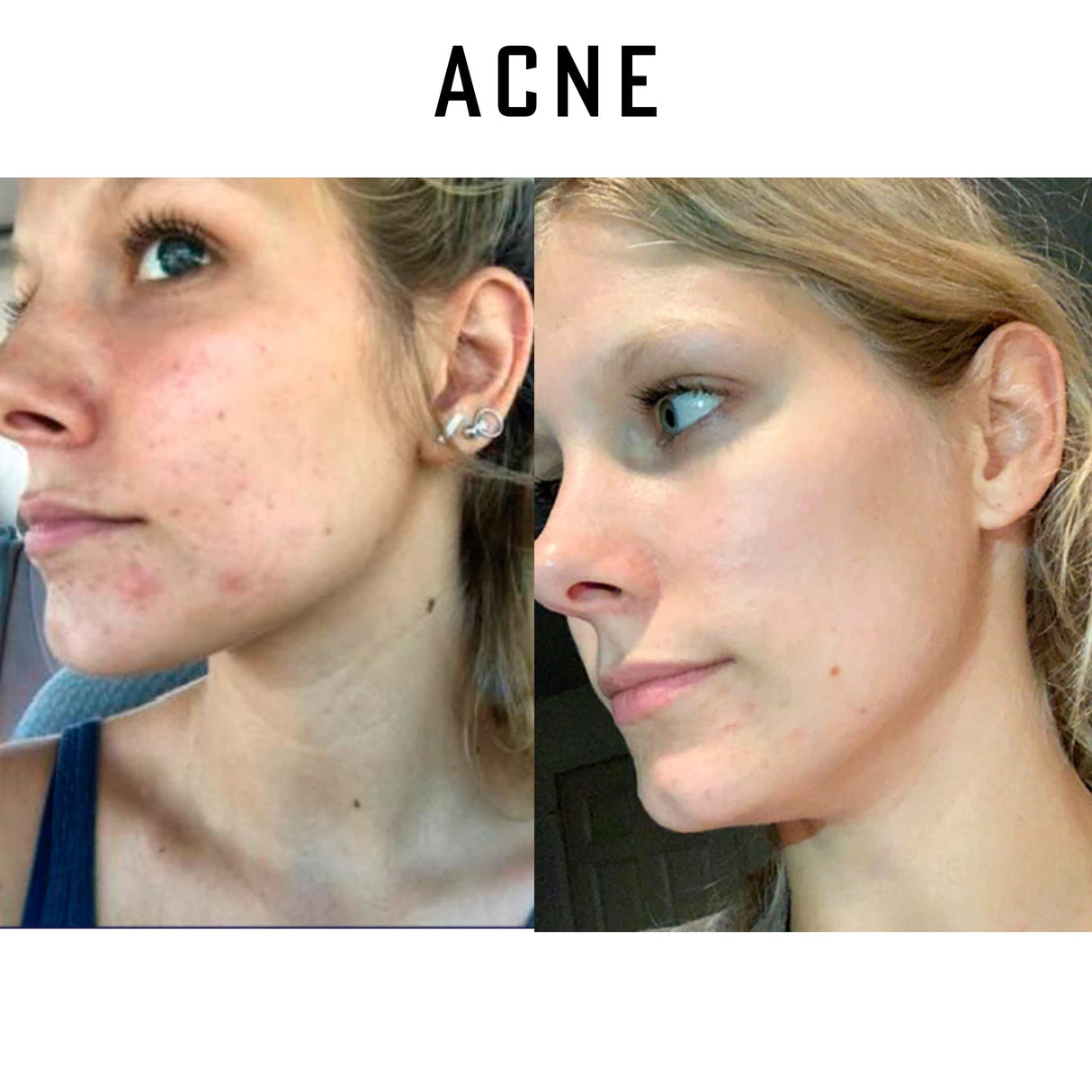 Simply O3 Pure Organic Ozonated Olive Oil Extra Strength 1200 Peroxide For Face and Skin Helps In Acne, Anti-Aging, Wrinkles and Rosacea For Sensitive Skin Made in Spain