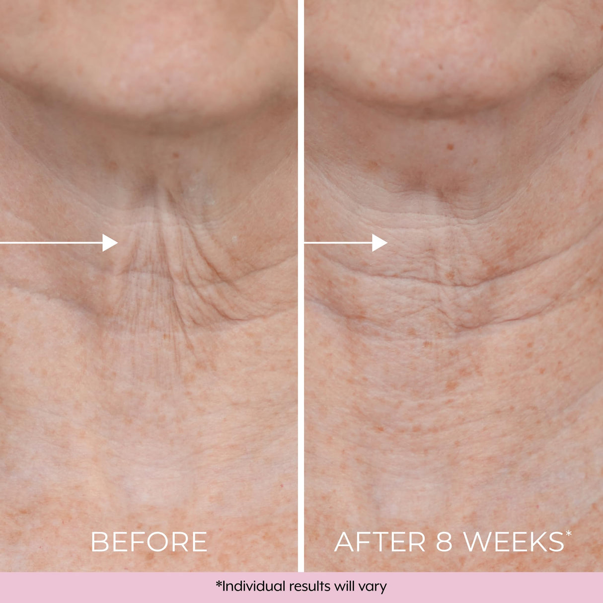 DEKLIDERM Neck Firming Cream – Anti Aging Retinol Cream Visibly Reduces Neck Wrinkles and Sagging – Neck Cream for loss of Firmness