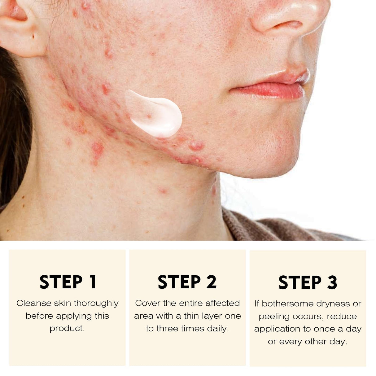 Acne Treatment Cream for Face & Body - Anti-acne Moisturizer for Teens & Adults - Spot Treatment for Breakouts & Blemishes - 30g