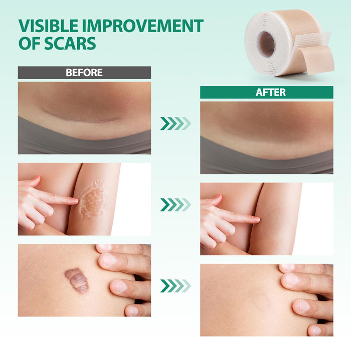 Medical Grade Silicone Scar Sheets (1.6” x 120” Roll - 3M), Professional Silicone Scar Tape, Reusable Silicone Scar Strips, Scar Remove Treatment for Acne Scars C-Section & Keloid Surgery