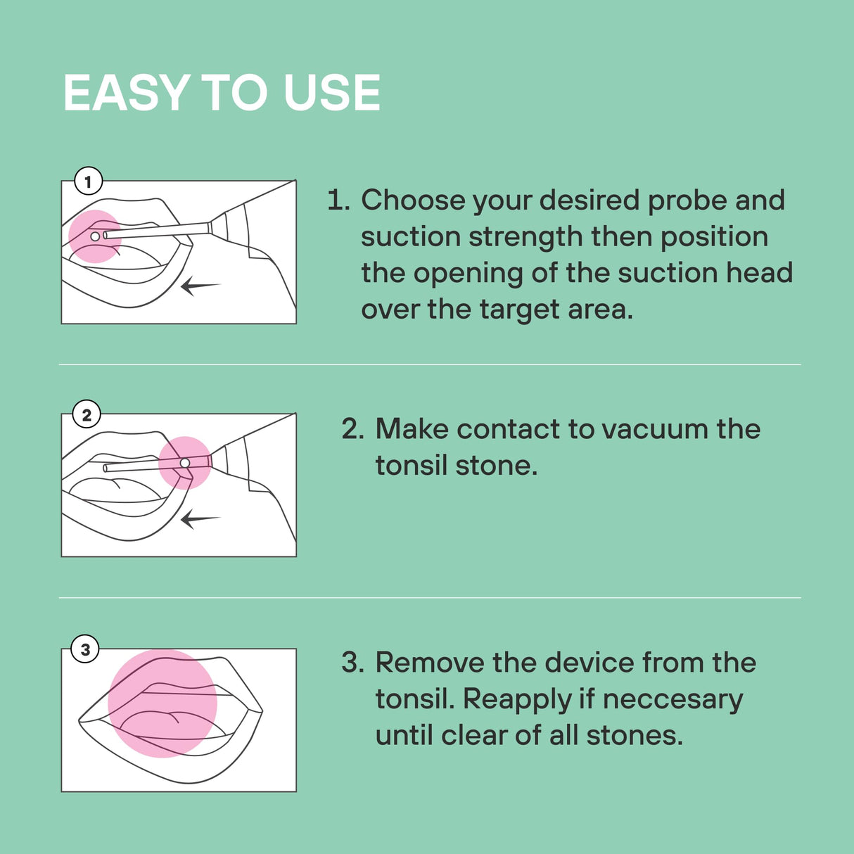 Electronic Vacuum Tonsil Stone Remover with LED Guidance Light - Hassle-Free Instant Suction - Tonsil Stone Removal Kit - Patent Pending (White)