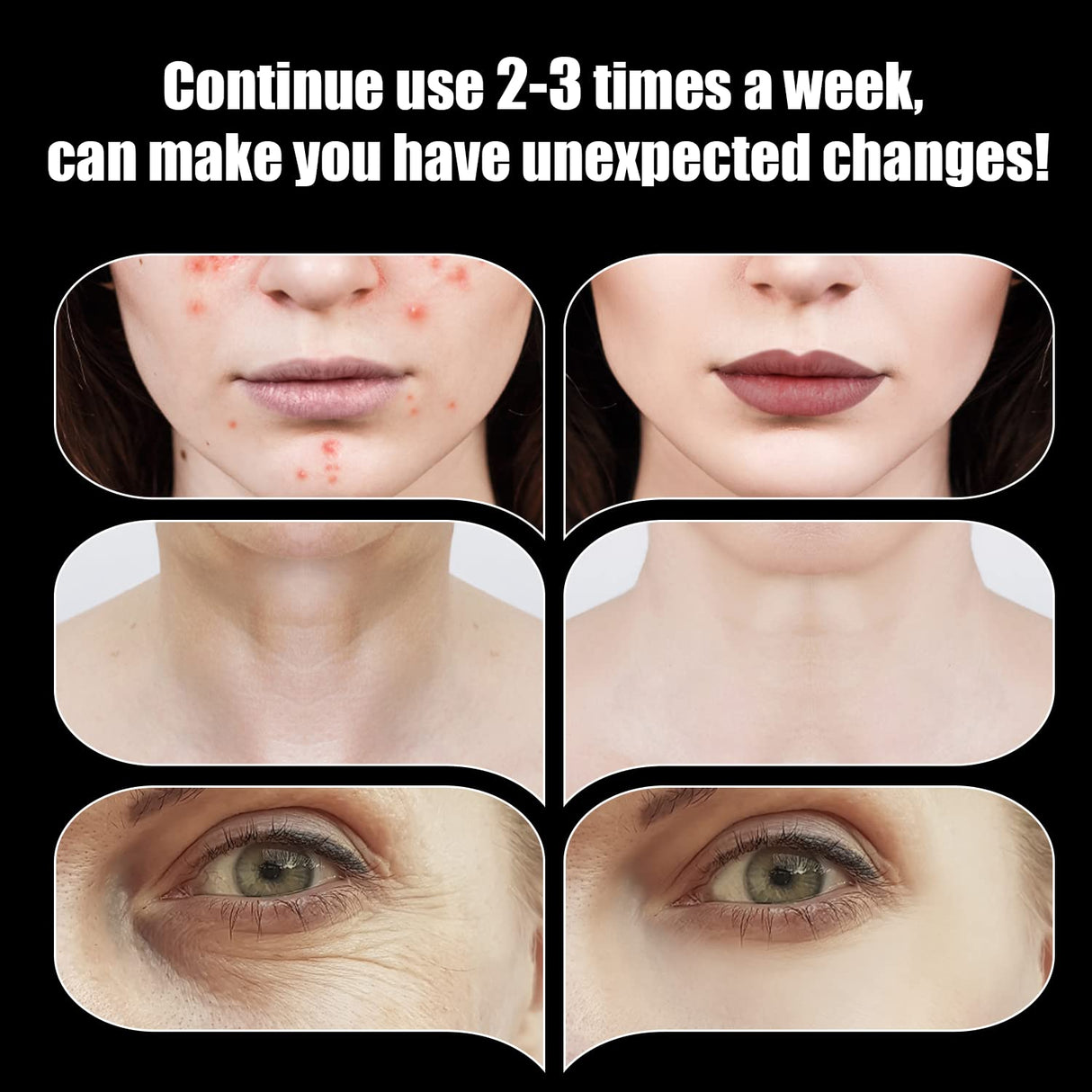 High Frequency Facial Wand - UUPAS Portable High Frequency Facial Machine with 6 Pcs Different Tubes(Orange & Purple)