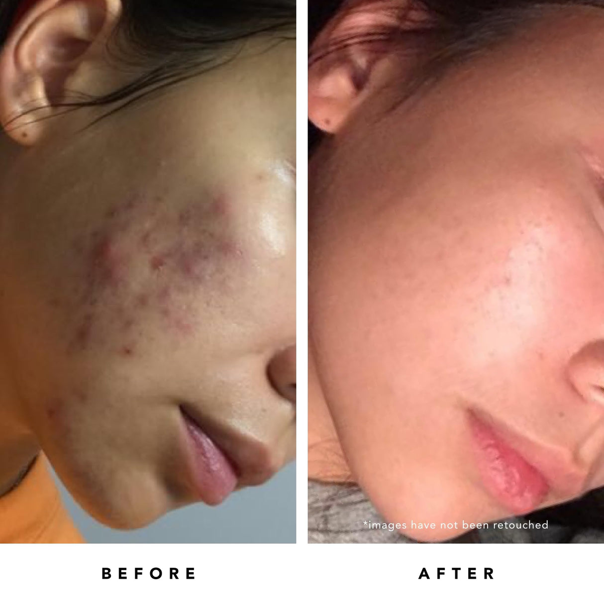 HERBIVORE Blue Tansy BHA & Enzyme Pore Refining Mask - Naturally Clarifies Acne, Blemishes & Redness, Vegan & Cruelty-Free, 60 mL / 2.02 oz