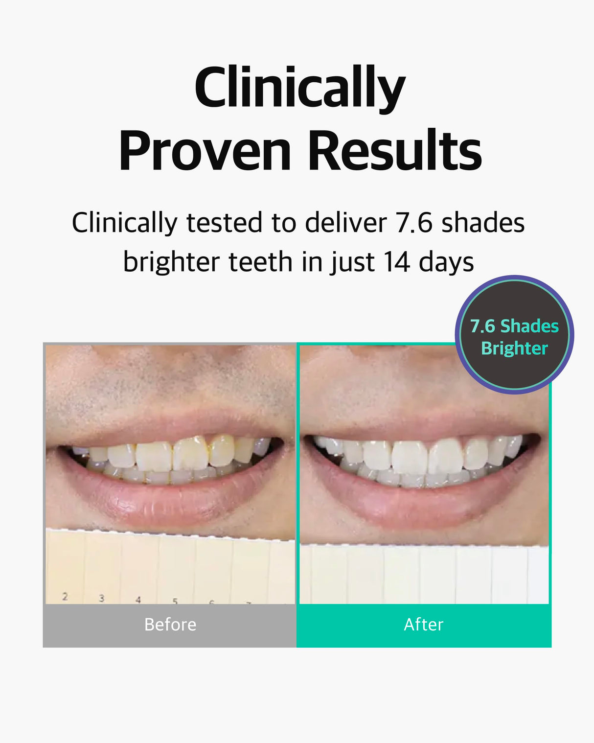 Live Orals PureDia Teeth Whitening Kit - Gel & Mouthpiece Set, Hydrogen Peroxide, Dentist Formulated for Sensitive Teeth, 28 Treatments.