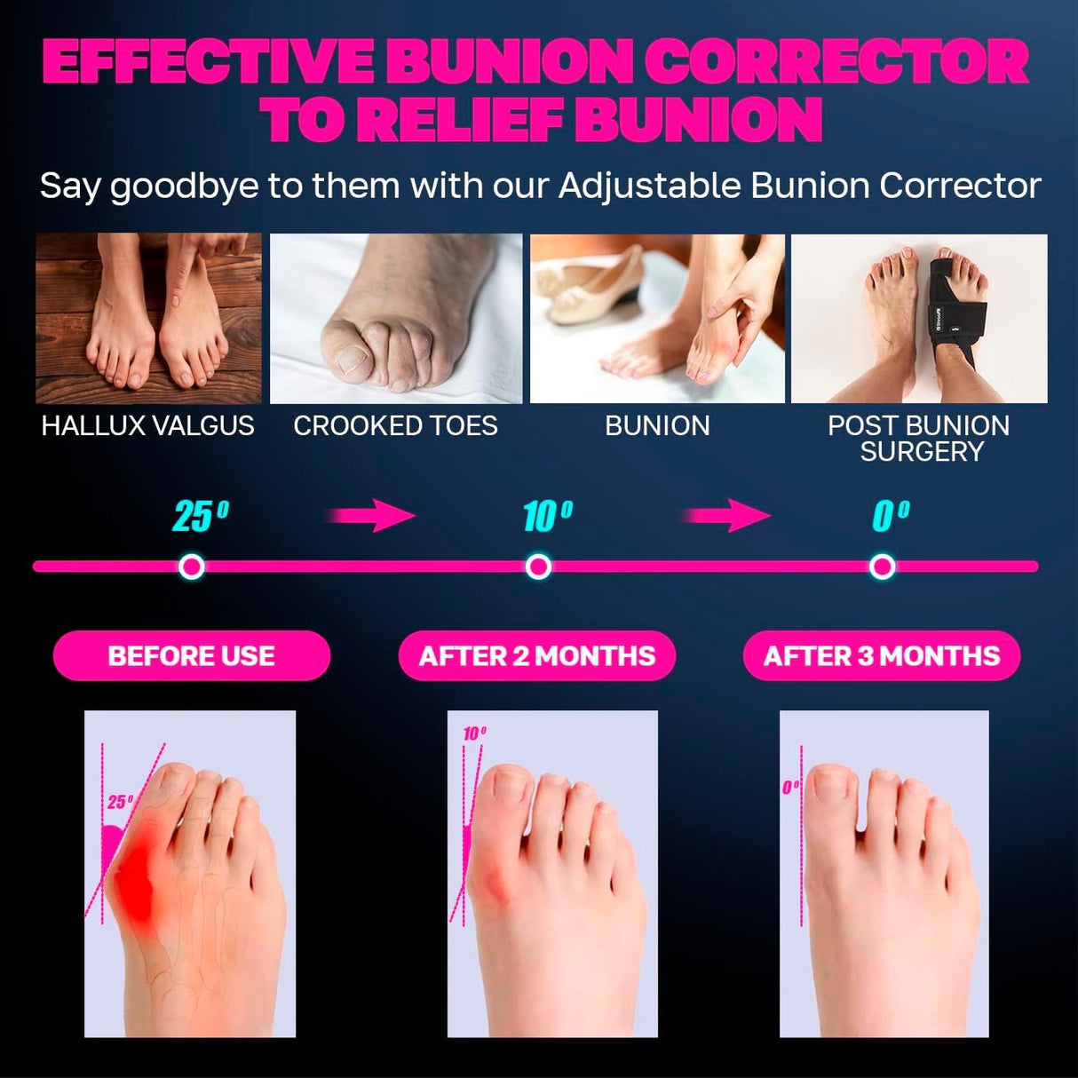 ShrooFit Effective Bunion Corrector for Men & Women | Relief Kit with Cushion Sleeves | Toe Straightener – Large/X-Large