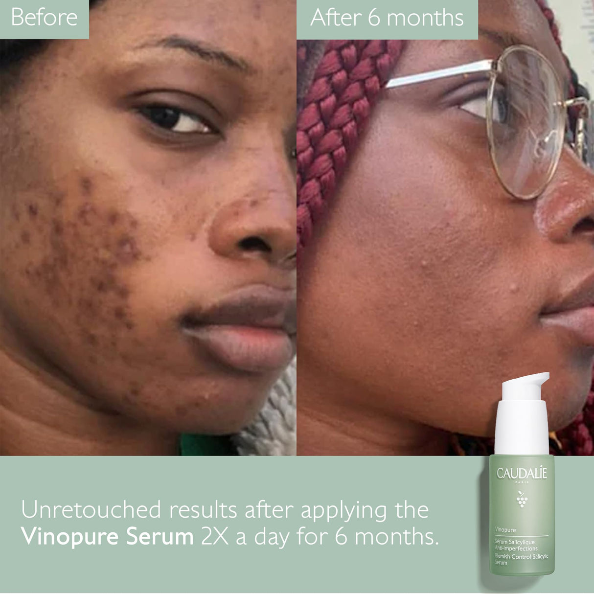 Caudalie Vinopure Natural Salicylic Acid Pore Minimizing Serum, 1 Fl Oz