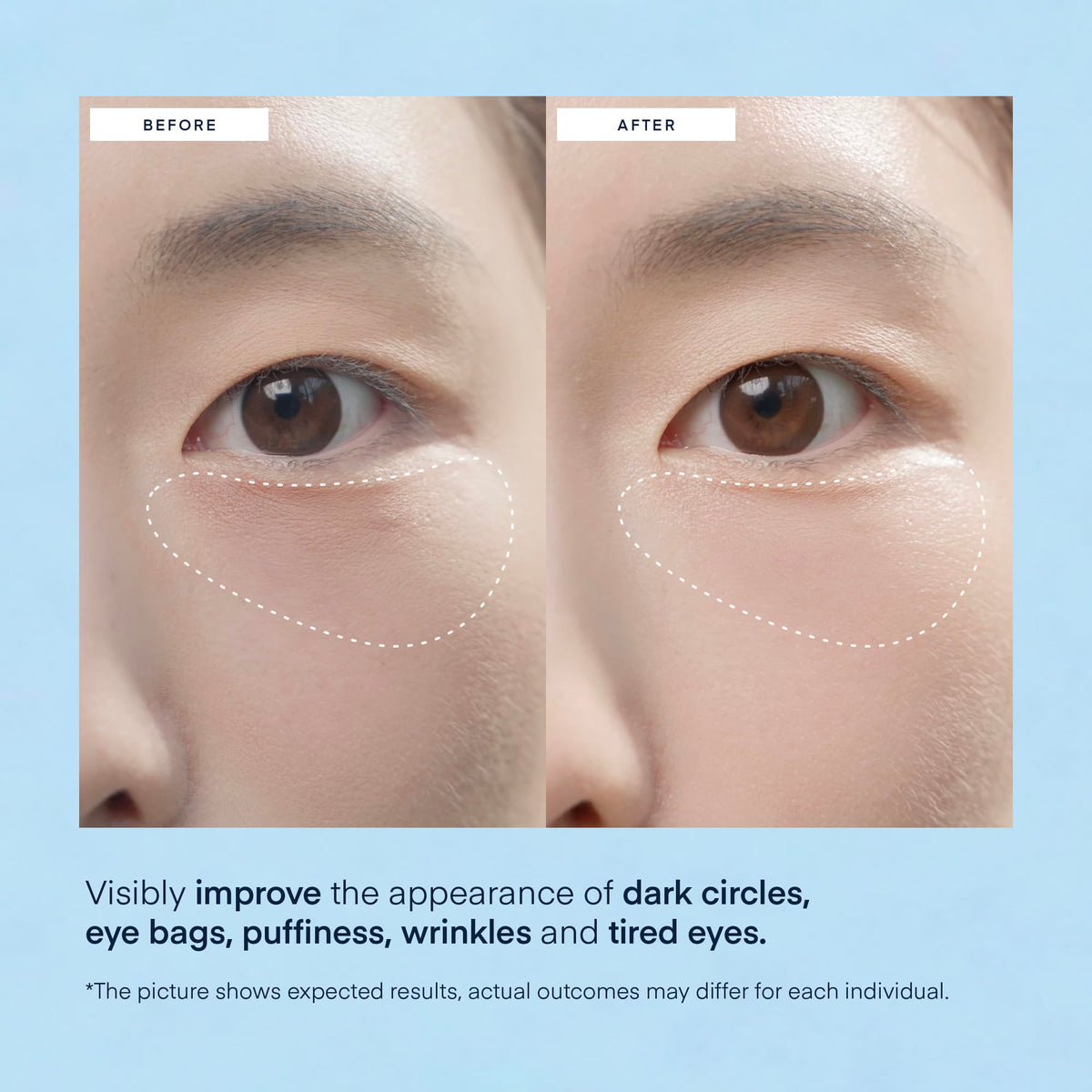 TEREZ & HONOR Caffeine Under Eye Patches - 60 Korean Hydrogel Eye Masks for Puffy Eyes & Dark Circles with Hyaluronic Acid & Niacinamide - Undereye Hydrating & Cooling, Vegan, Fragrance-Free