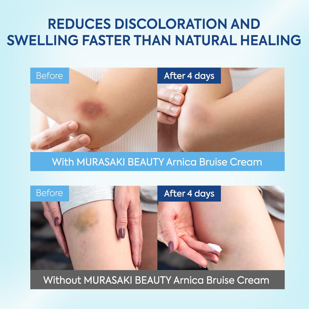 MURASAKI BEAUTY Arnica Bruise Cream Extra Strength: Fast Healing for Bruising and Swelling on Thin & Sensitive Skin