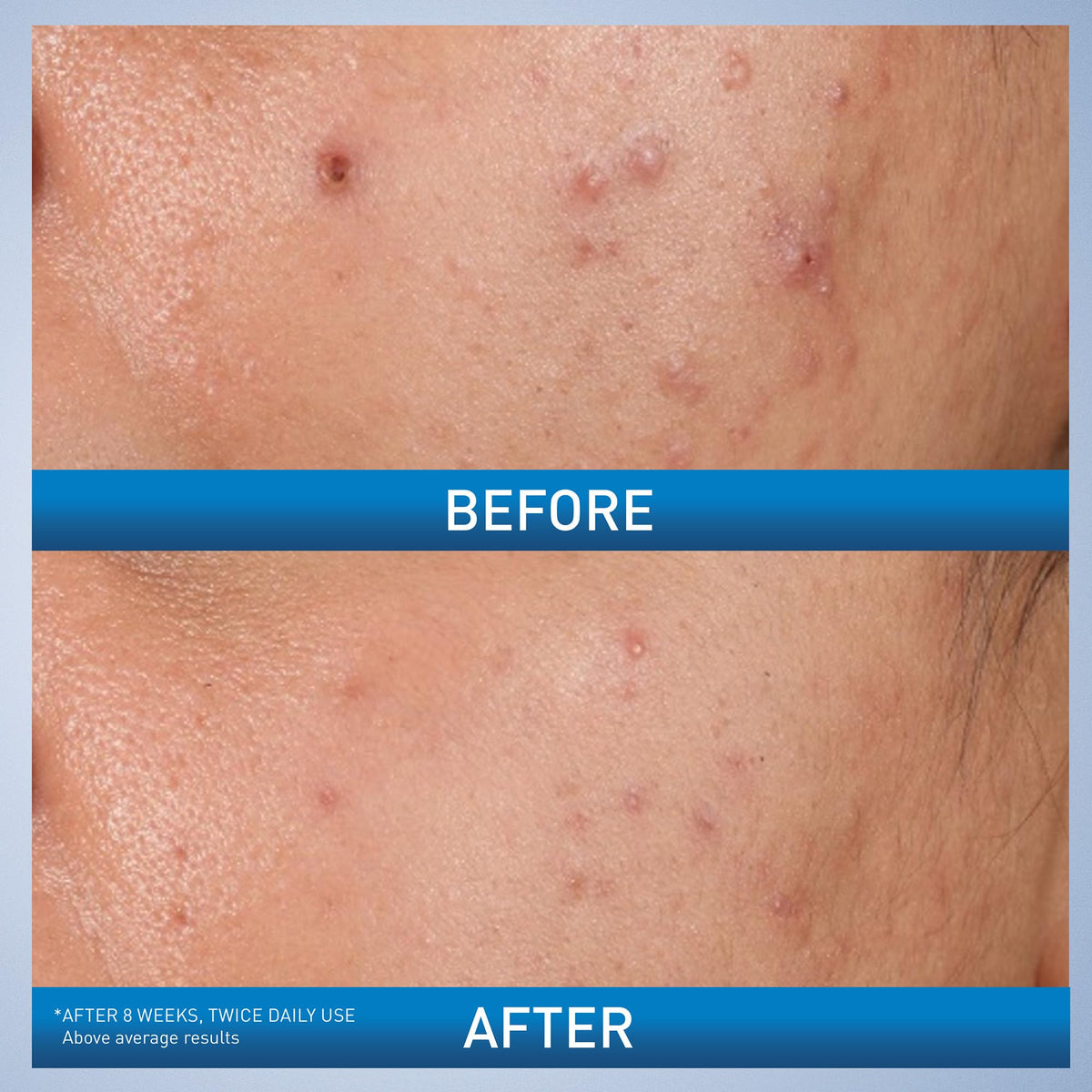 CeraVe Acne Control Gel, Salicylic & Glycolic Acid Face Treatment, 1.35oz