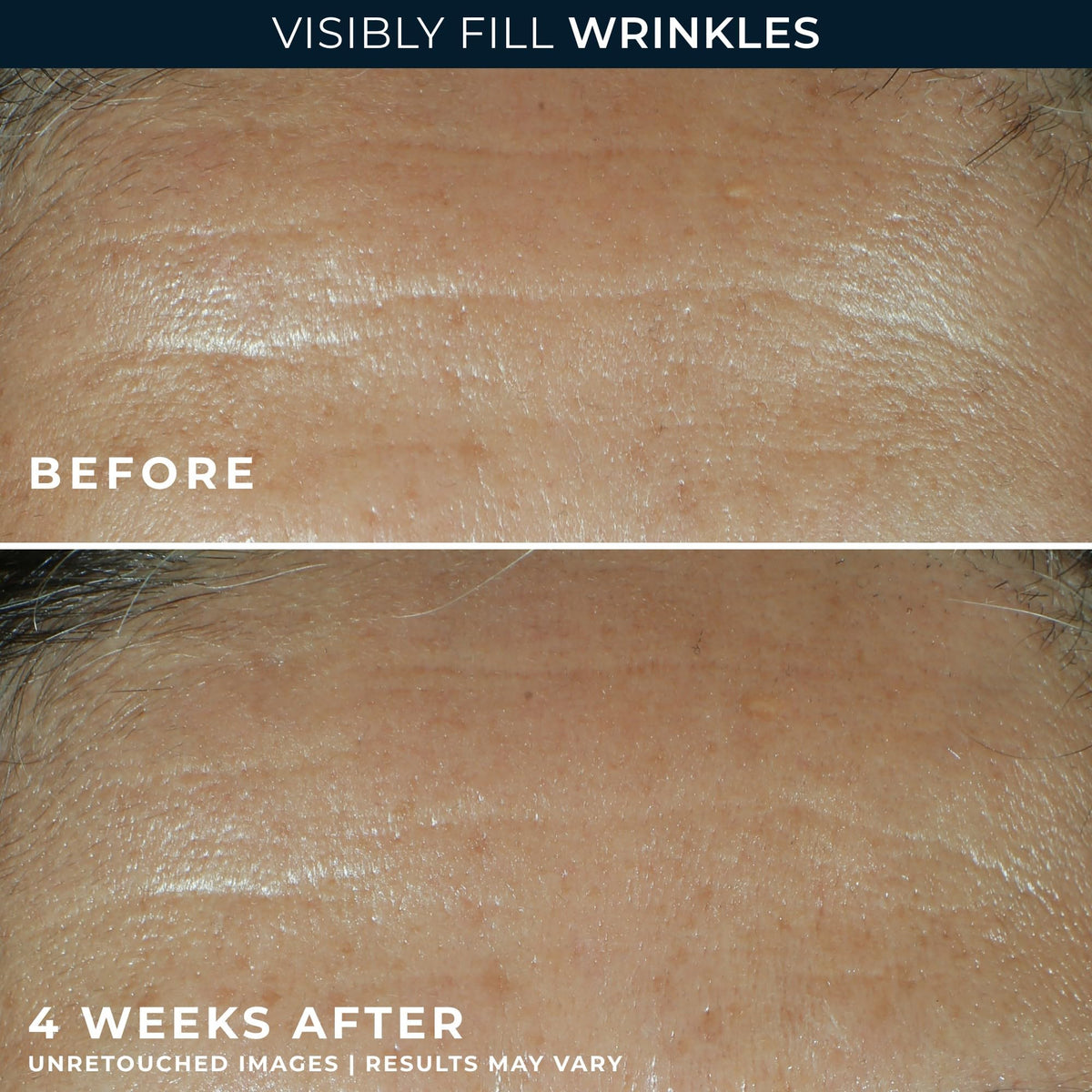 RoC Retinol Correxion Wrinkle Filler for Deep Wrinkles with Hyaluronic Acid