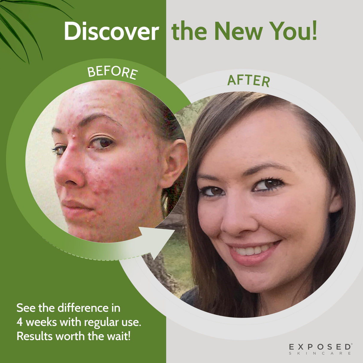 Exposed Skin Care Acne Treatment Kit - Includes Facial Cleanser, Clearing Tonic, Acne Treatment Serum, Clear Pore Serum, Clarifying Mask, Cloth - Natural Acne Solution for Face, All Ages & Skin Types