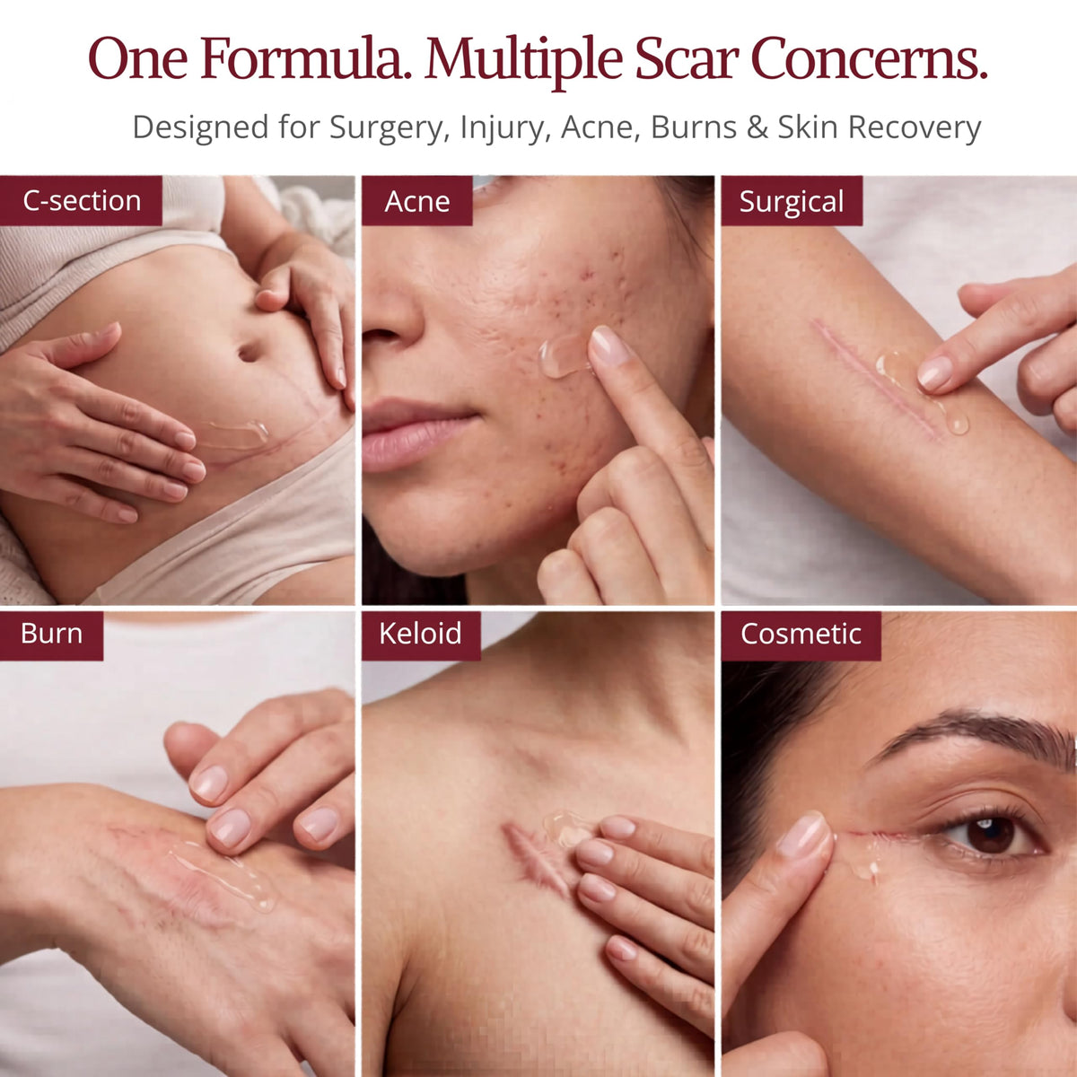 HealFast Silicone Scar Gel - Medical Grade Scar Cream for Surgical Scars