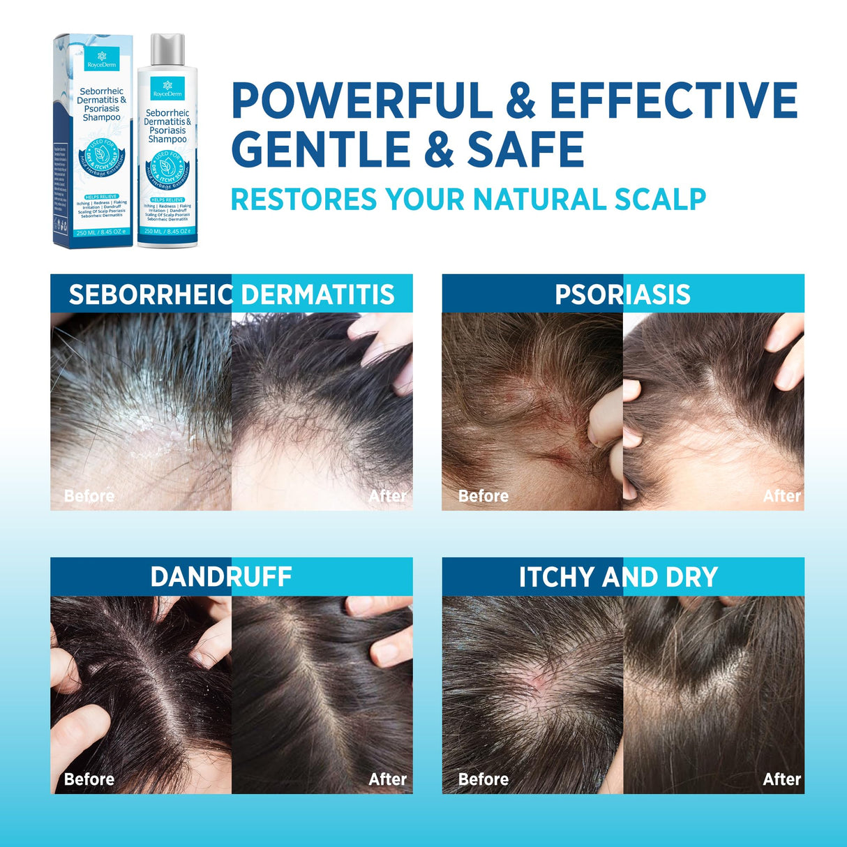 Seborrheic Dermatitis & Psoriasis Cream, Shampoo and Conditioner Set - Scalp Therapy System for Folliculitis, Psoriasis, Dandruff, Dry Scalp - Scalp Treatment to Relieve Itching, Flaking, Irritation