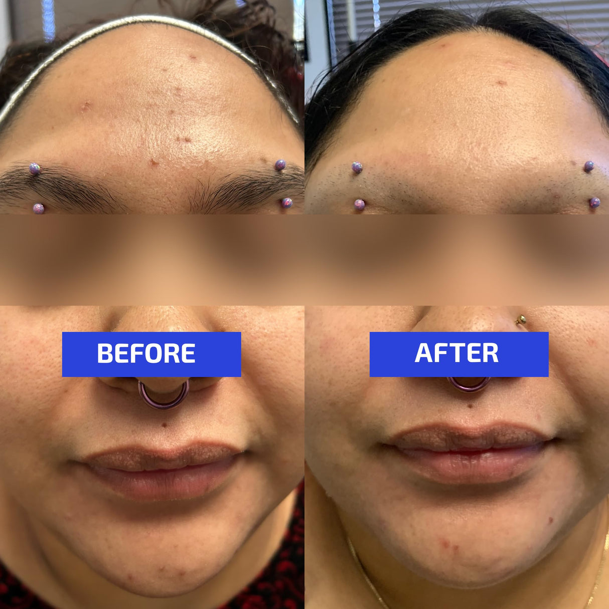 Codex Labs Shaant Clear Skin Supplement – 60 Vegan Capsules | Acne Probiotics with 9-Strain Blend, Green Tea EGCG & Guggul – Daily Support for Acne-Prone Skin & Clear Complexion