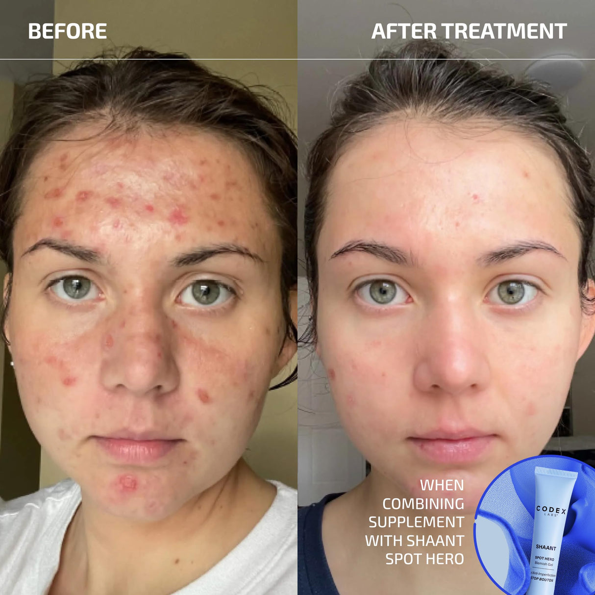 Codex Labs Shaant Clear Skin Supplement – 60 Vegan Capsules | Acne Probiotics with 9-Strain Blend, Green Tea EGCG & Guggul – Daily Support for Acne-Prone Skin & Clear Complexion