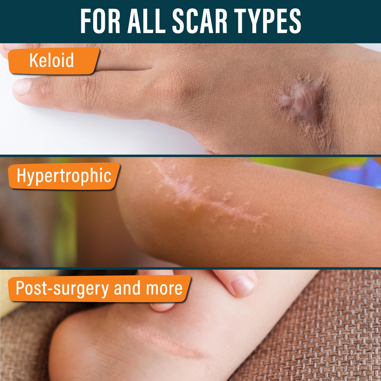 NUVADERMIS Silicone Scar Tape for Kids - Scar Tape for Surgical Scars - 120" x 1.5" Roll - Reusable Medical Grade Silicone Scar Tape for Children - 1 Pack - Dinosaurs