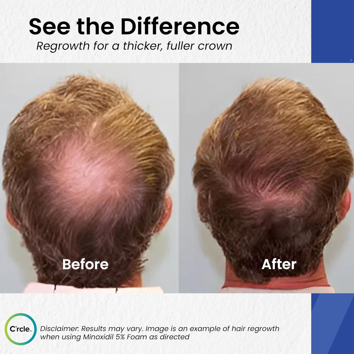 C’rcle Men's Minoxidil 5% Foam - 6 Month Supply - Helps Restore Vertex Hair Loss & Thinning Hair - Extra Strength Supports Hair Regrowth for Men, Unscented Hair Loss Treatments for Men