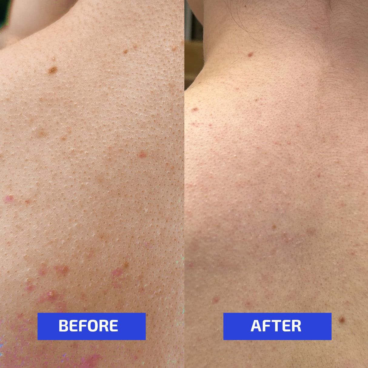 Codex Labs Shaant Clear Skin Supplement – 60 Vegan Capsules | Acne Probiotics with 9-Strain Blend, Green Tea EGCG & Guggul – Daily Support for Acne-Prone Skin & Clear Complexion