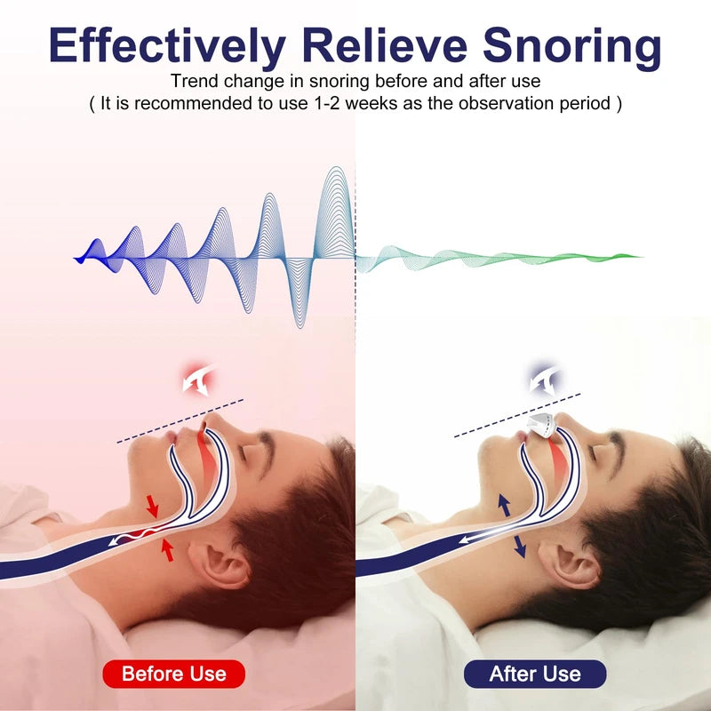 Anti Snoring Device,Electric Stop Snoring Solution,Adjustable Wind Speed Breathable Snoring Prevention for Men Women,Universal All Nose Shapes(White)