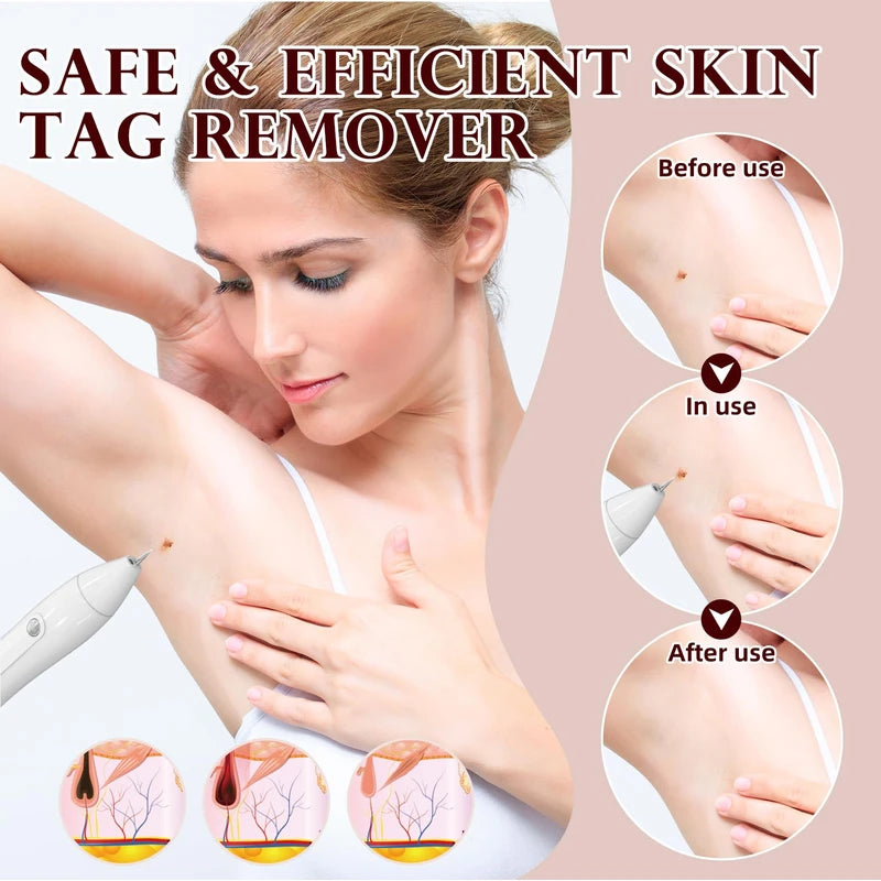 Breaspec LM 1000 SkinTag Remover Home Use, Removal of Common Warts, SkinTags | Easy to Use