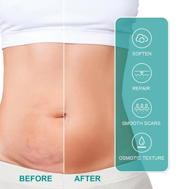 South Moon (Buy 1 Get 1 Free)South Moon Scar Care Spray Fades Scare pregnancy Smoothing Skin Care Spray Medical Grade Scar Spray - Specification: Buy 2 Get 2 Free