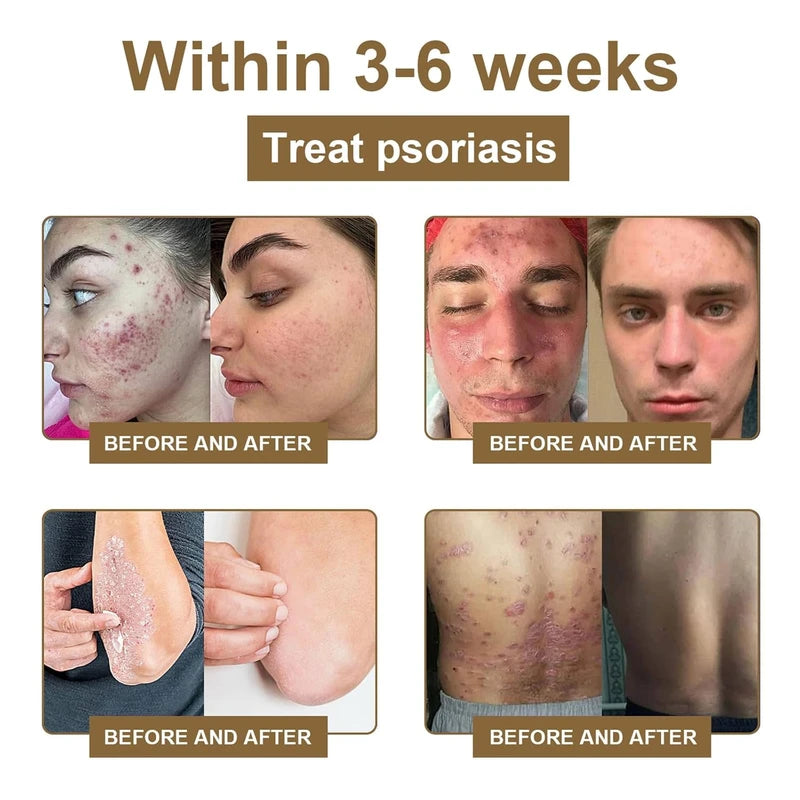 LOVILDS Bee Venom Spray - Remove Spots for Men Women, Bee Venom Spray, Bee Venom Skin Spray for All Parts of the Body (2PCS)