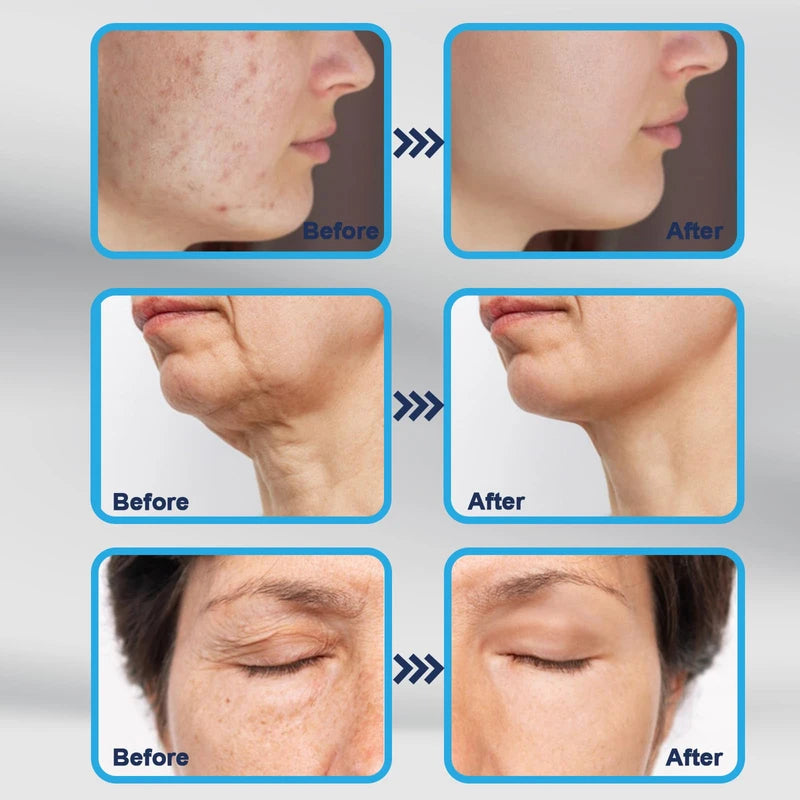 E DERMA STAMP 140 Adjustable 0-3mm