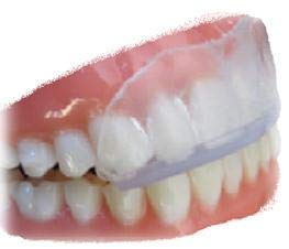 SmartGuard Dental Guard Night Guard for Clenching, Bruxism, and Grinding Dentist Designed Includes 2 Guards, 1 Travel Case, and a 60-Day Supply of Premium Cleaning Crystals