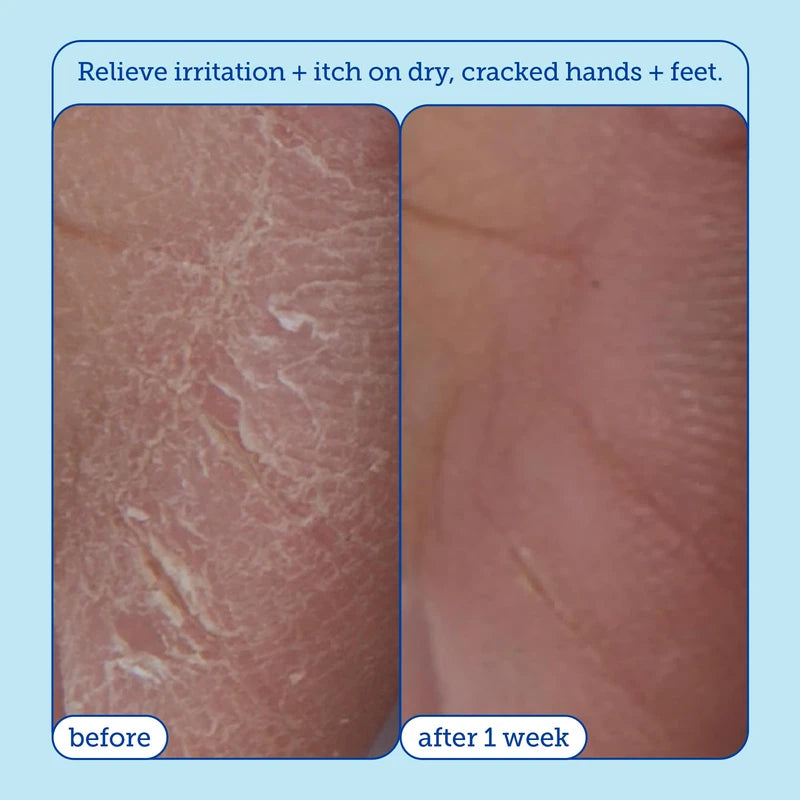 Skinfix Skinfix Eczema+ Hydrating Hand Repair Cream: To Address Eczema & Dry, Cracked, Sensitive skin, 3 FL Oz