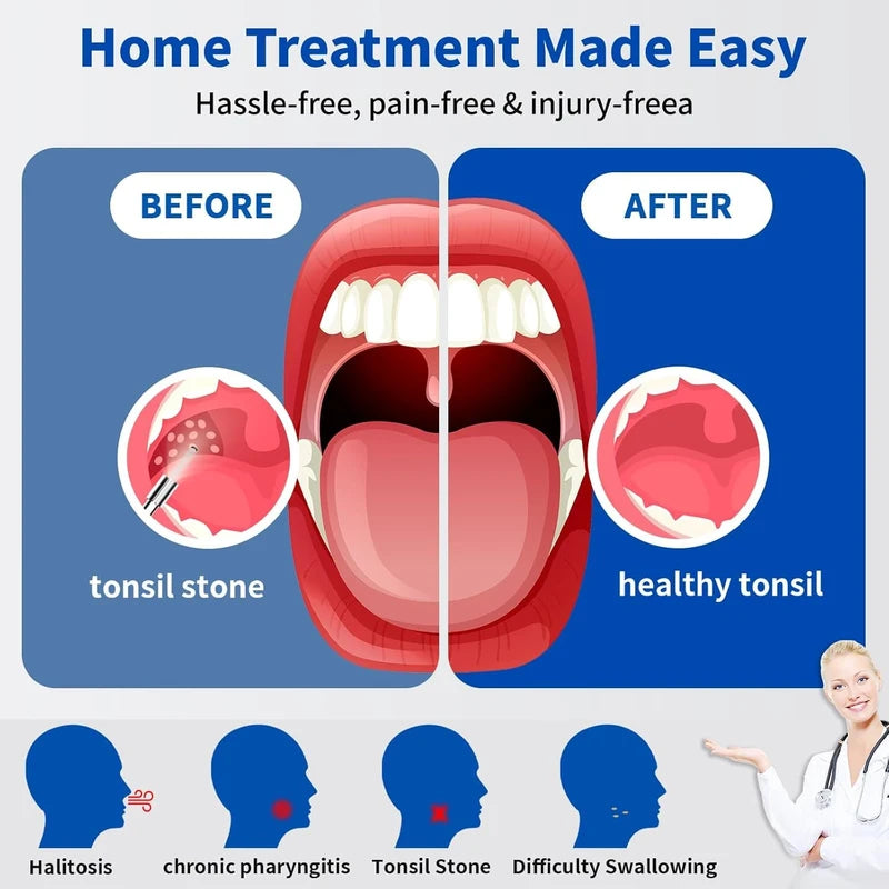 Tonsil Stone Remover Kit with Camera, Visual Tonsil Stone Removal Tool with LED Light, Rechargeable Tonsillolith Removal Tool with 4 Head - Fight Bad Breath - Attachments for iOS & Android(Black)