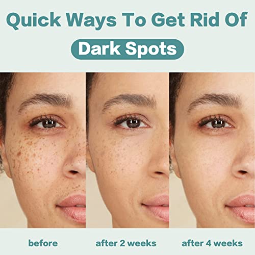 CITYGOO Dark Spot Remover for Face: Dark Spot Corrector Cream - Natural Ingredient,Enriching Skin Care For All Skin Tones - Melasma, Freckle, Sun Spot Remover & Blemish Reducer-1.7 FL OZ