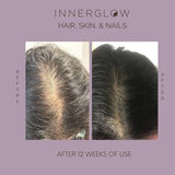 Inner Glow Advanced Hair, Skin & Nails Formula - Dermatologist and Plastic Surgeon Developed, clinically Tested for visibly Stronger and Thicker Hair in 12 Weeks