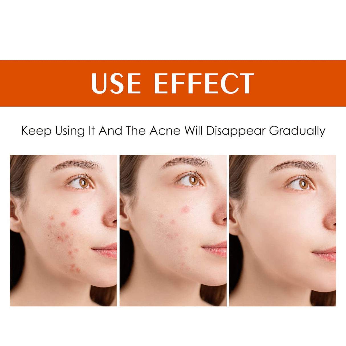 Acne Treatment Cream for Face & Body - Anti-acne Moisturizer for Teens & Adults - Spot Treatment for Breakouts & Blemishes - 30g