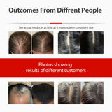 Laser Hair Growth Cap, Red Light Therapy for Hair Regrowth, Laser Therapy Cap for Hair Loss, Hair Loss Treatments Hat for Men & Women