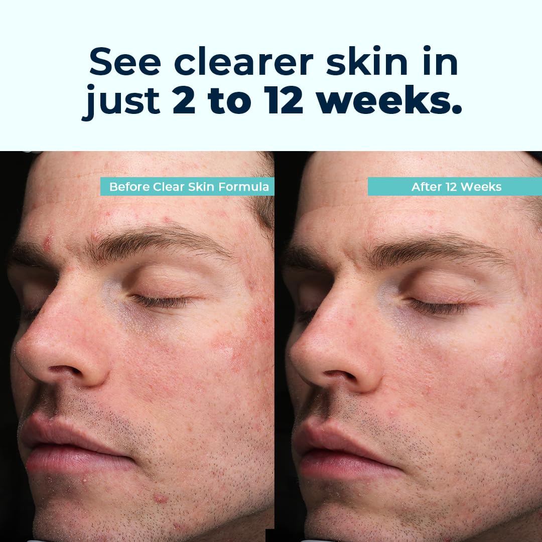 VitaMedica Clear Skin Vitamin Formula | Noncystic Acne Supplement for Skin Clearing | Breakout Treatment for Women and Men | Vitamins A, C, E, Selenium, Chromium, and Zinc for Skin Health | 2 Pack