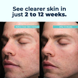 VitaMedica Clear Skin Vitamin Formula | Noncystic Acne Supplement for Skin Clearing | Breakout Treatment for Women and Men | Vitamins A, C, E, Selenium, Chromium, and Zinc for Skin Health | 2 Pack