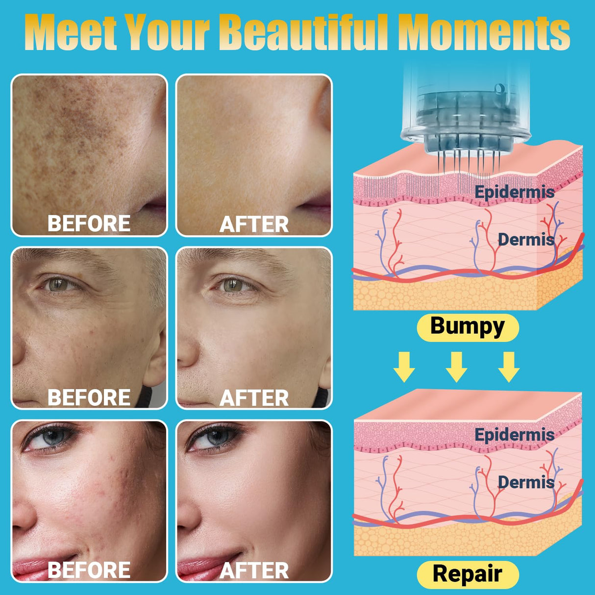 Home Use Microneedling Microneedle Skin Care Beauty Kit Tool for Face Hair Beard