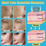 Home Use Microneedling Microneedle Skin Care Beauty Kit Tool for Face Hair Beard