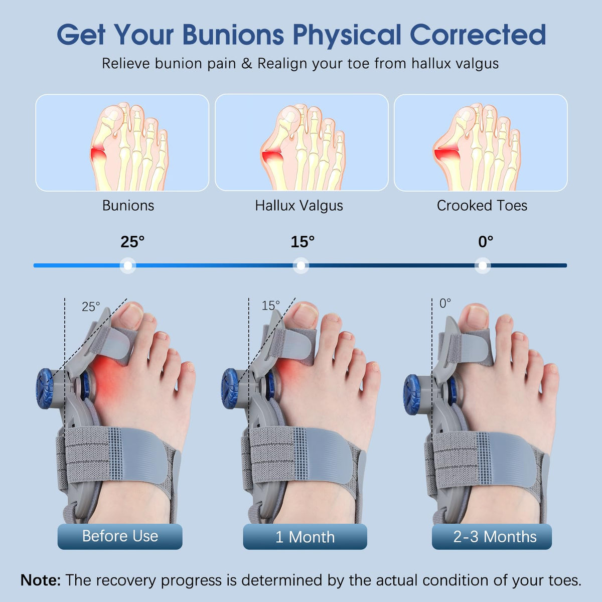 KASHEVI Bunion Corrector for Women & Men Big Toe: Adjustable Bunion Fi ...